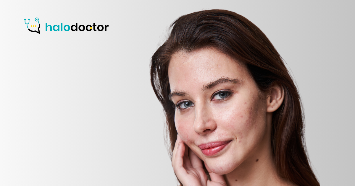 Trądzik młodzieńczy: co może przepisać dermatolog online?